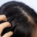 डैंड्रफ से निजात पाने के लिए फॉलो करें ये टिप्स