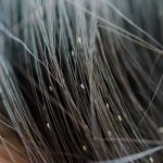 बिटिया के बालो में पड़ गई हैं जूं, ऐसे पाएं निजात