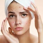 ये उपाए करेंगे मुहांसों को दूर, फेस पे आएगा निखार