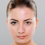 मुहांसों छीन लेते है फेस की खूबसूरती, करें ये घरेलू उपाय