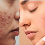 मुहांसों के दाग से निजात पाने के लिए ट्राई करें ये टिप्स