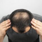 लड़कों में भी होती है हेयर लॉस की समस्या, करें ये उपाय