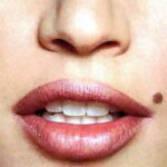 तिलों से मिलेगा छुटकारा, अपनाएं ये तरीके