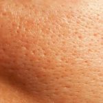 ओपन पोर्स ने छीन ली खूबसूरती, तो इन टिप्स से पाएं छुटकारा