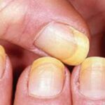 पीले नाखूनों से मिलेगा छुटकारा, ट्राई करें ये उपाय