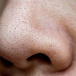 जिद्दी ब्लैक हेड्स से मिलेगा छुटकारा, इस जबरदस्त हैक्स से मिनटों में पाएं साफ स्किन