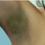 काले अंडरआर्म्स में आज़माएं ये टिप्स, दूर हो जाएगी समस्या