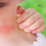 मच्छर काटने पर करें इसका प्रयोग, मिलेगी राहत